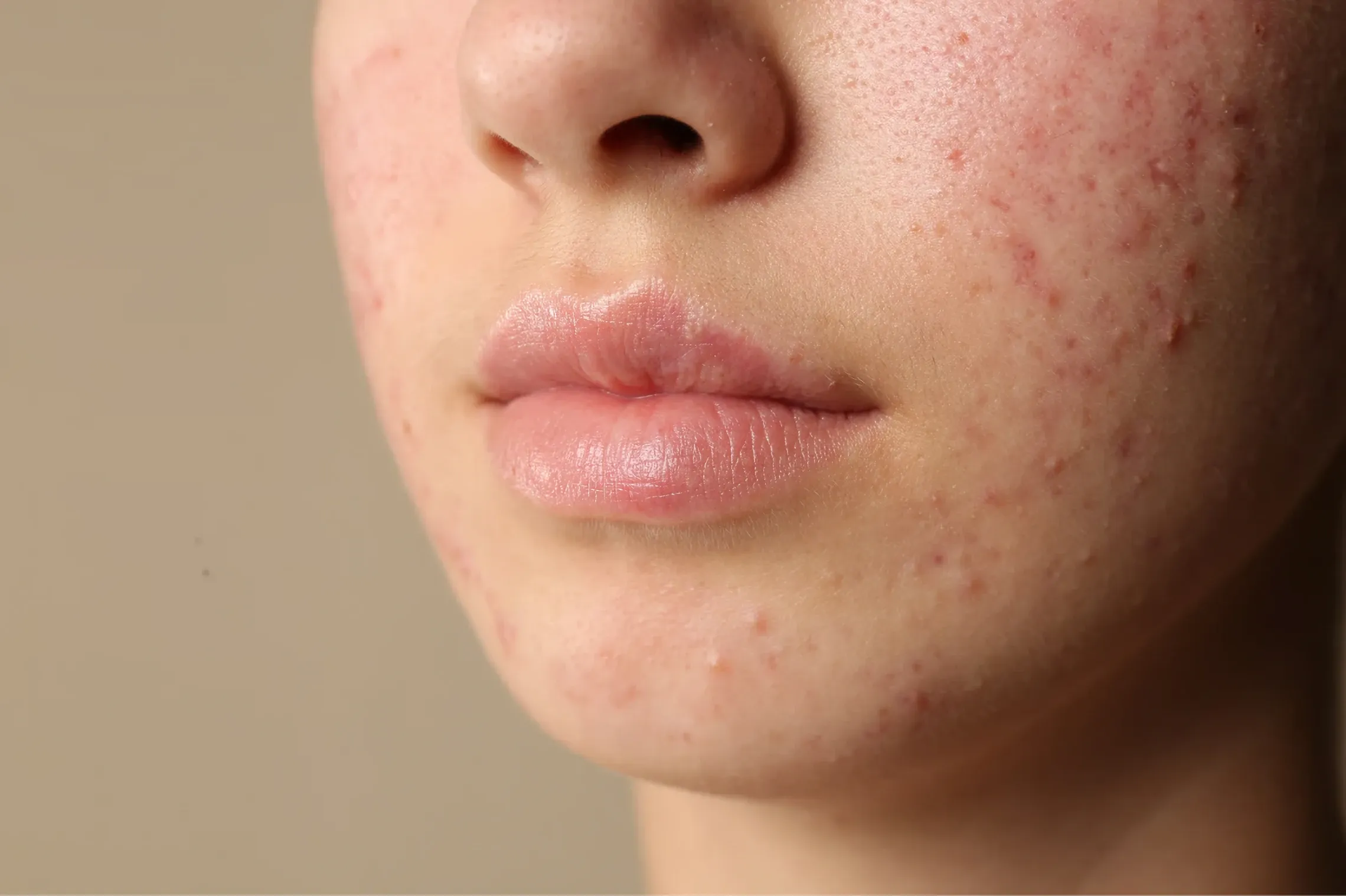 Trattamento acne e cicatrici